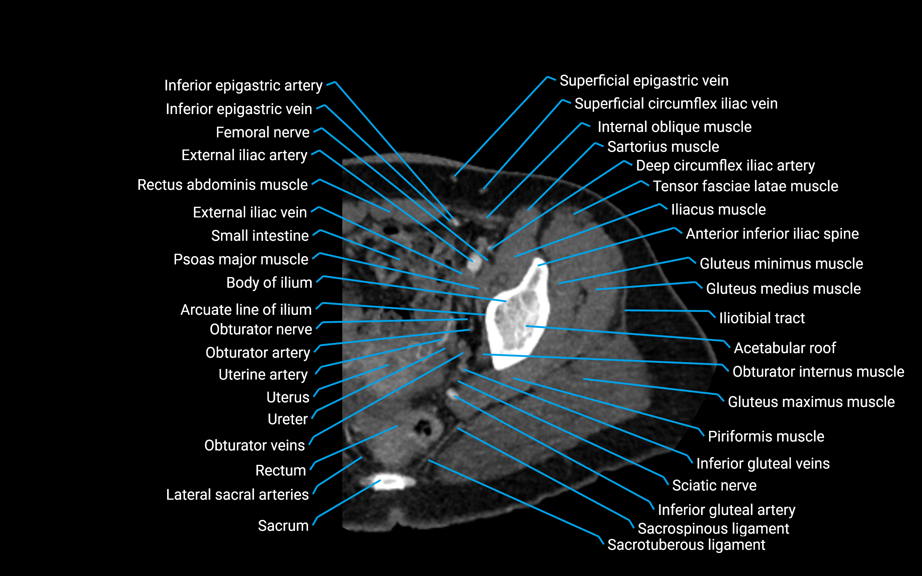 CT Hip axial cross sectional anatomy labelled image 1 (4).png